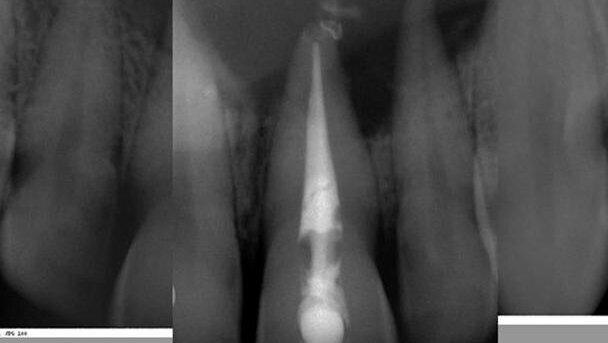 Large periapical lesion management: Decompression combined with root-canal treatment