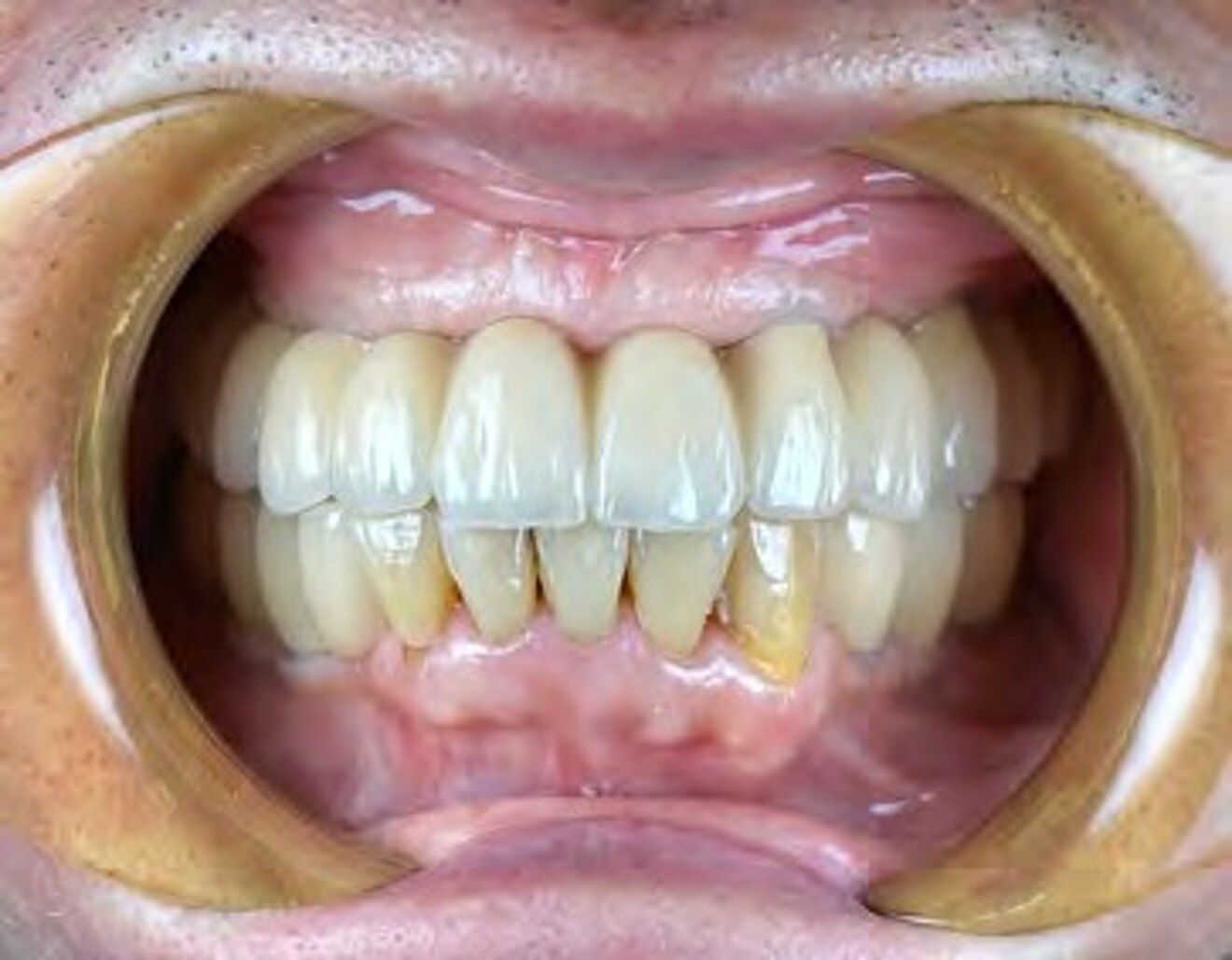  Fig. 5b: Post-treatment smile view following full-mouth implant-supported rehabilitation.