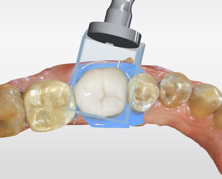 Fig. 19d: CAD workflow for tooth #36: positioning of the restoration in the virtual block before milling.