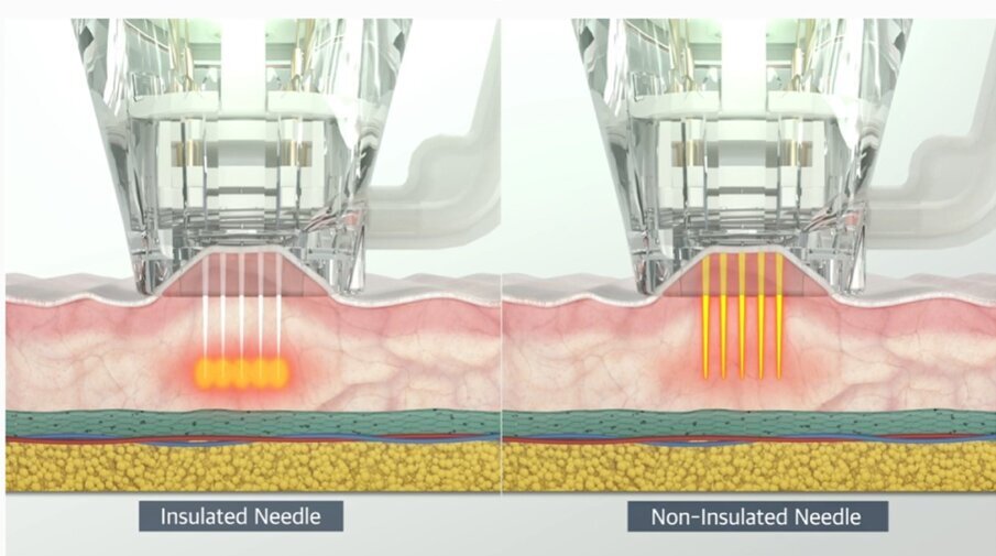 Fig. 1 - Fig. 1 - Modalità di penetrazione intradermica degli aghi del needling RF (Fonte: Eunsung Global).