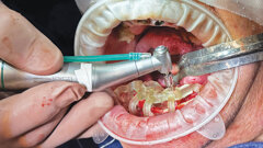 Precision and predictability with NeoBiotech’s NaviGuide Guided Surgery System