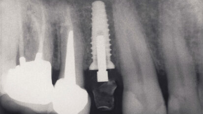 Occlusione su impianti: considerazioni per la pratica quotidiana