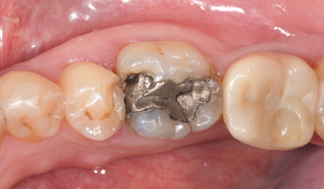 Fig. 14a: Pre-op clinical view of tooth #36 showing the old amalgam restoration and the extent of the carious lesion.