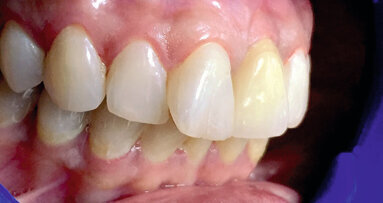 Mise en place immédiate dans la zone maxillaire intéressée par l’esthétique