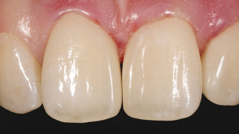 Zatvaranje dijastema kompozitom. Poseban izazov ili standardna situacija?