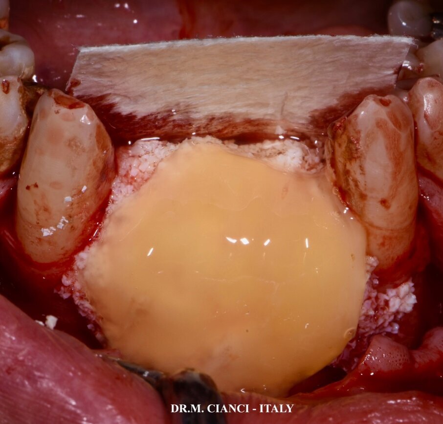 Fig. 3 - GBR orizzontale e verticale con materiale alloplastico e PRGF.