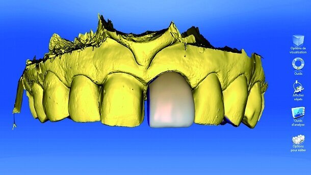Réhabilitation esthétique antérieure par CFAO directe : à propos d’un cas clinique