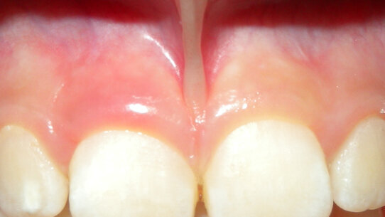 Frenulectomia Laser Nd:Yap gold standard della chirurgia orale pediatrica: a case report