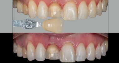 Estetyczne możliwości leczenia w ramach rehabilitacji okluzji – część 1