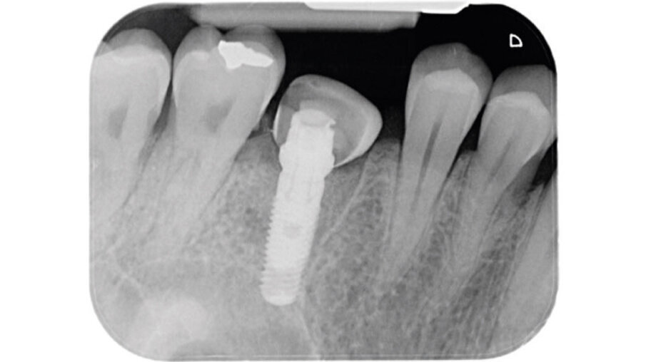 Fig. 7 - Radiografia di controllo dopo il posizionamento della vite di guarigione customizzata.