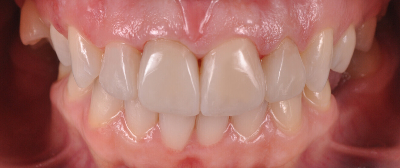 Fig. 20b: Treatment outcome. Retracted view (b).