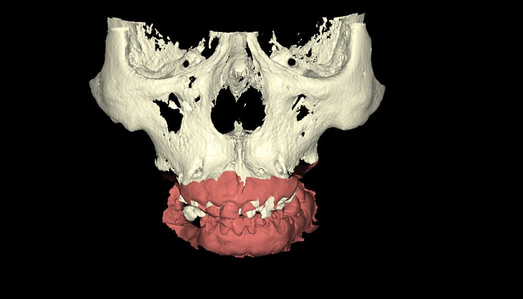 Fig. 2a: 3D reconstructions used for diagnostic assessment and treatment planning. Merged intra-oral scan and CBCT reconstruction of the maxilla and mandible.