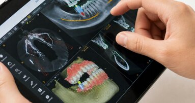IA aproxima-se de especialistas no planeamento de implantes