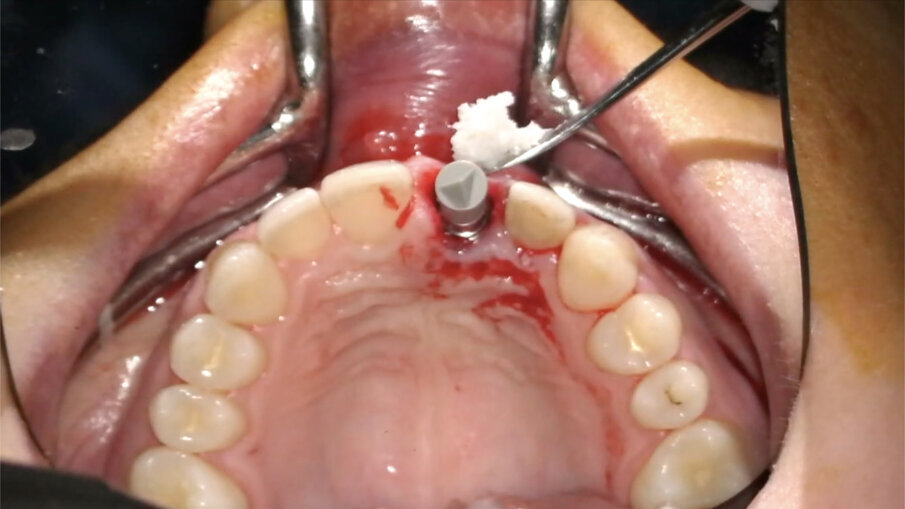Fig. 18_Posizionamento del biomateriale.
