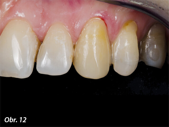Obr. 12: Výsledek okamžitě po sejmutí kofferdamu.
