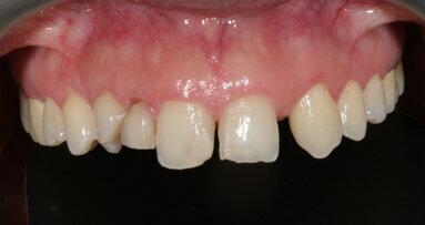 Tratamientos provisionales perfectos