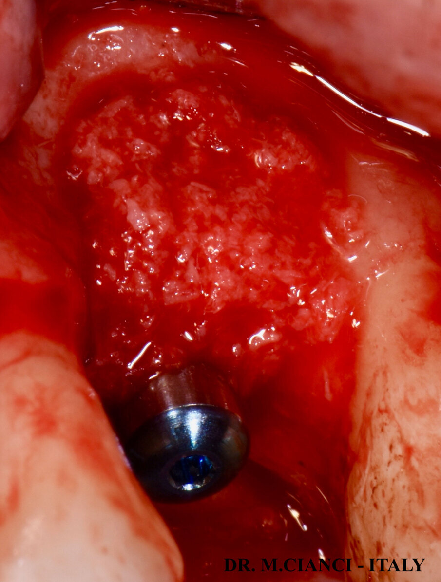 Fig. 8 - GBR con osso autologo e PRGF® frazione 2.
