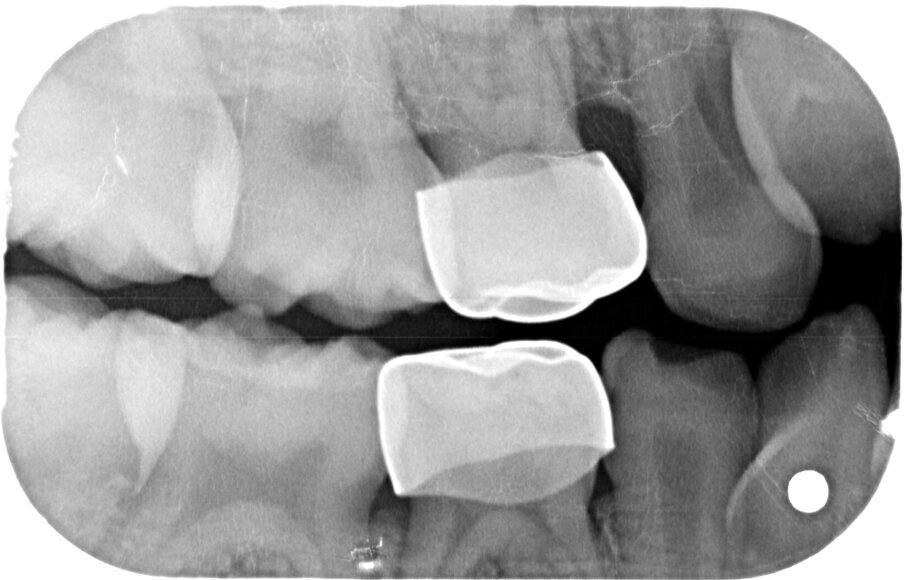 Afbeelding 13a-b. Casus 4: 04-03-19. BWR en BWL na 1 jaar in 2 tempi middels de Hall-techniek succesvol zonder spuit, boor of angst behandeld.