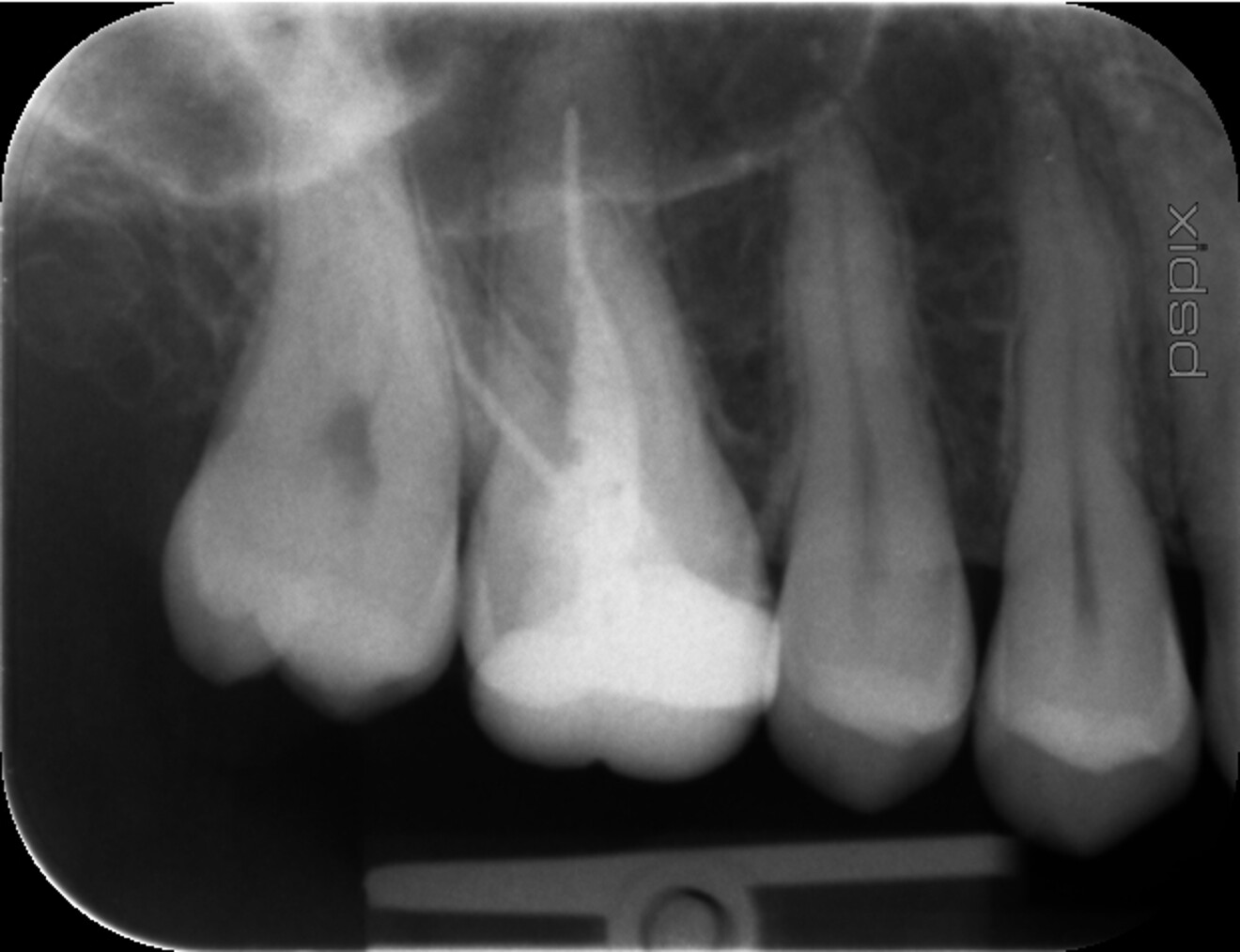 Fig. 8: Second radiograph taken for reassessment of the initial situation, confirming the inadequate quality of the previous root canal treatment.