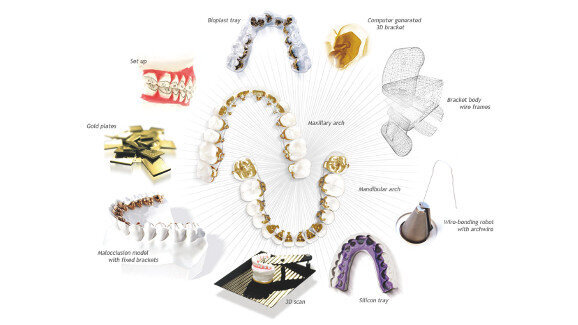 Non-extraction treatment of a Class II case with a missing mandibular central incisor using a CAD/CAM lingual orthodontic system