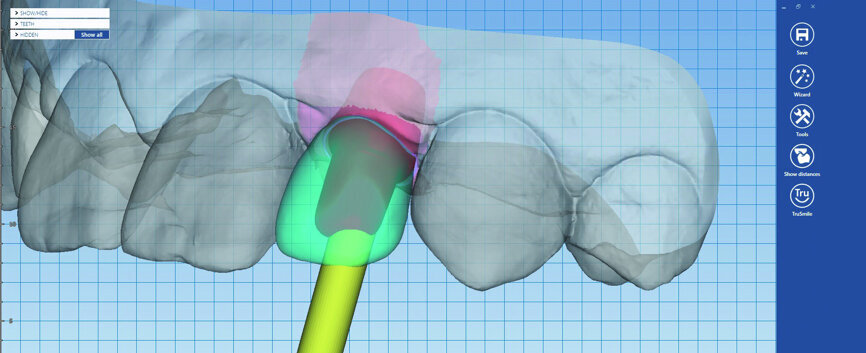 Fig. 19: The final restorations were designed in Planmeca PlanCAD Premium.
