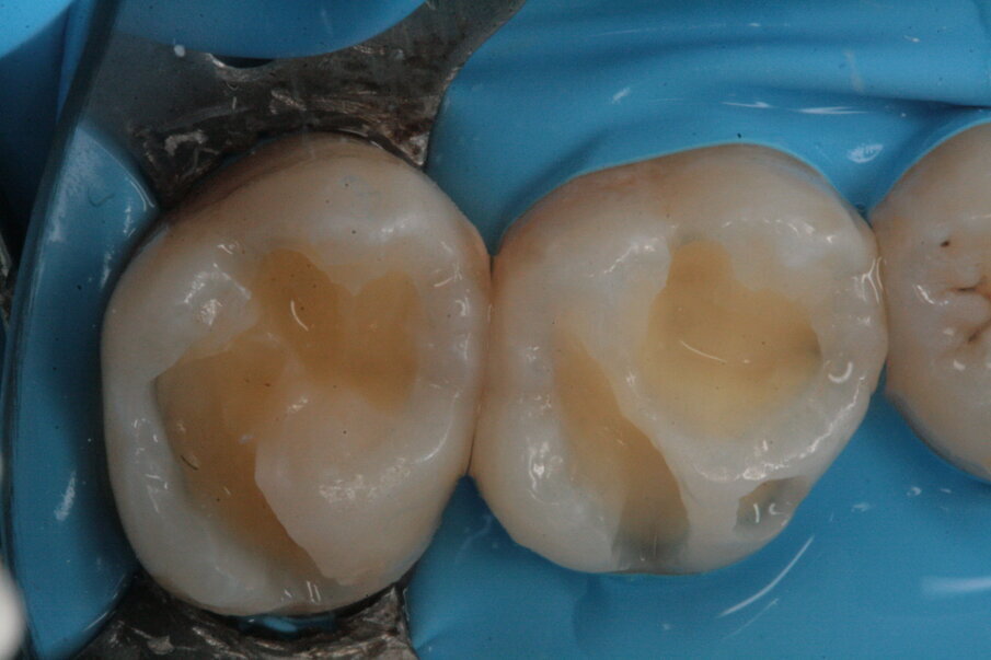 Fig. 7_Preparazione delle cavità di 16 e 17.