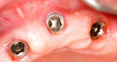 Saudi dentists receive U.S. patent for novel soft tissue augmentation tech