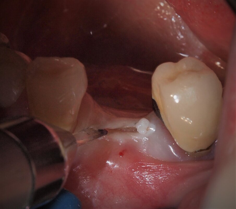 Fig. 4 - Caso clinico 1. Incisione dei tessuti molli con laser a diodi da 915 nm e inserto in zaffiro. L’inserto viene condotto lentamente con un movimento simile a quello della lama fredda.