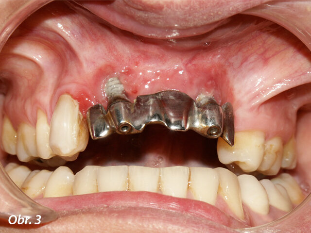 Vyšetření po třech letech: negativní krátkodobá prognóza implantátů v důsledku výrazné recese u pravého implantátu a hyperplastických tkání.
