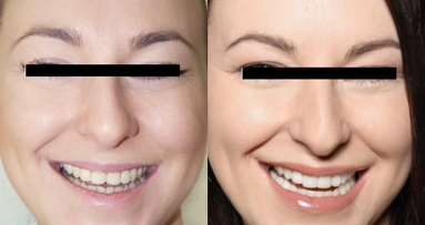 Bonding – sposób na udoskonalenie uśmiechu