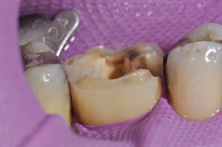 Fig. 5: Preparación de un hombro ancho como base para la forma retentiva. 