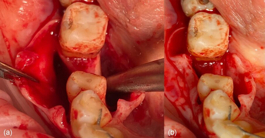 Fig. 5_a) Rilascio del lembo buccale dopo incisione periostea, b) passivazione del lembo linguale dopo il rilascio del muscolo miloioideo.