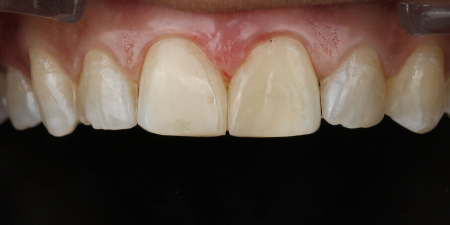 Fig 10. Post op after Finishing and polishing