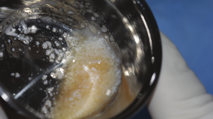 Figure 14:  Combination of bovine bone and PRF (Sticky bone).