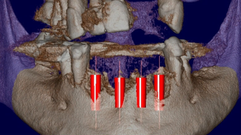 Diagnosi e pianificazione digitale pre-chirurgica in Rigenerazione Ossea Guidata