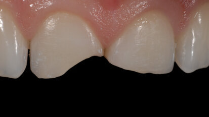 Un nuevo concepto en la estratificación con resinas compuestas