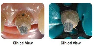 Enhanced clinical guide helps dentists save natural teeth