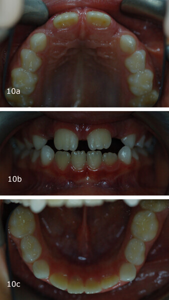 Figs. 10a–c: Comparison of the intra-oral photographs at the (a–c) start and (d–f) end of treatment.
