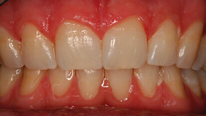 Valutazione dell’efficacia  dello sbiancamento professionale domiciliare con il nuovo Ena White 2.0: risultati a sei mesi allo spettrofotometro