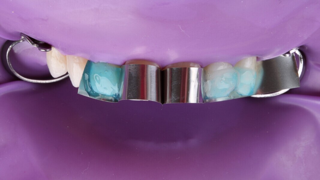 Fig. 8: Etsen met fosforzuur gel. Laat het 15 seconden inwerken op het glazuuroppervlak.