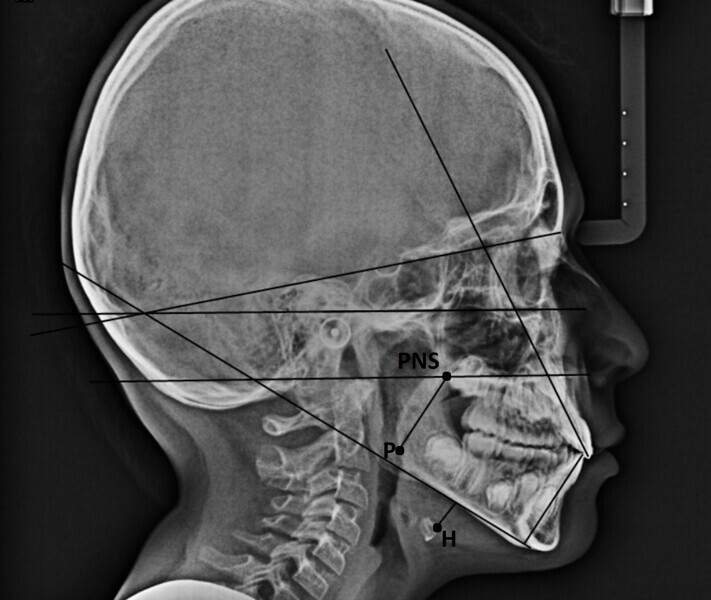 Fig. 15b: Comparison of the cephalometric radiograph and functional tracing at the (a) start and (b) end of treatment. PNS = posterior nasal spine; H = hyoid bone; P = tip of the soft palate.