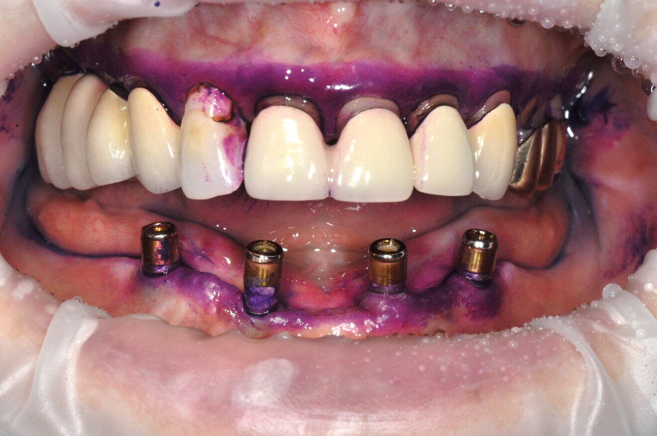 After disclosing the biofilm.