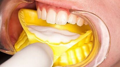 Profesjonalna i domowa profilaktyka u pacjentów z uzupełnieniami na wszczepach zębowych