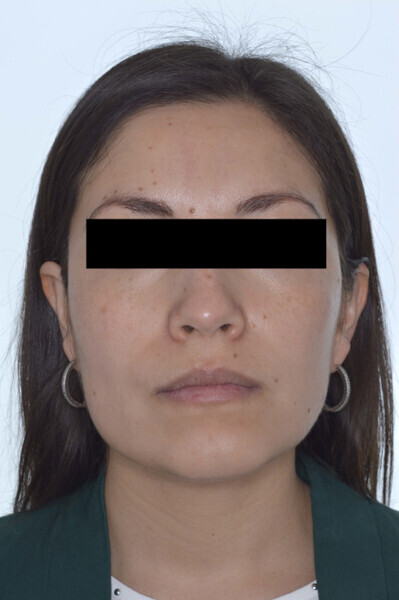 Fig. 8a: Final extra-oral photographs one month after botulinum toxin administration.