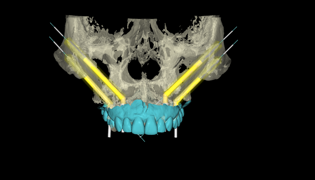 Fig. 3a: Virtual treatment planning showing four zygomatic implants supporting an FP 3 prosthesis in the maxilla.