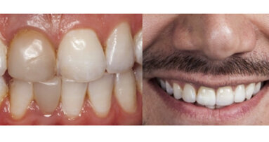 Dinámica lumínica en dientes anteriores con cerámica vítrea