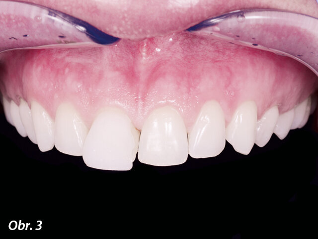 Po dokončení mock-upu na středním řezáku jej bylo možno digitálně naskenovat. Skenovat lze jakýmkoli intraorálním skenerem, který umí vytvářet STL soubory. Většina intraorálních skenerů převádí 3D sken do STL souborů automaticky. Pokud však zubní lékař nemá v ordinaci intraorální skener, zhotoví analogový otisk horní čelisti (nejlépe s přímo zhotoveným mock-upem na středních řezácích) a odešle jej do nejbližší zubní laboratoře, která skener vlastní. Zubní technik může zubnímu lékaři tento otisk digitalizovat, nahrát STL soubor do systému Rebel a objednávku dokončit prostřednictvím nasdílení odkazu.