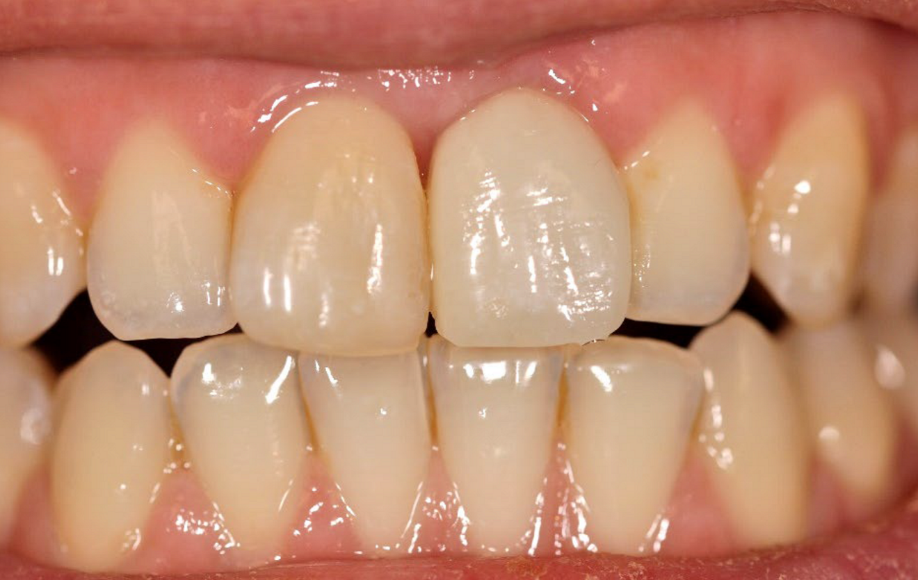 ... and intra-oral view 32 weeks post-op (d).