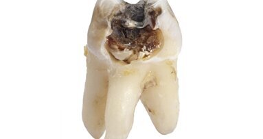 Gene beeinflussen Kariesprävalenz