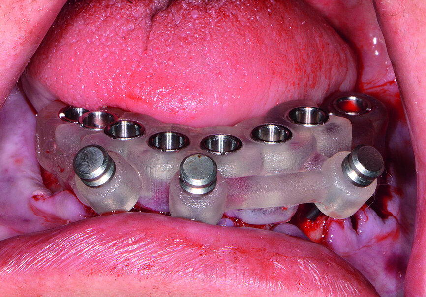 Fig. 14: Mandibular surgical guide stabilised.